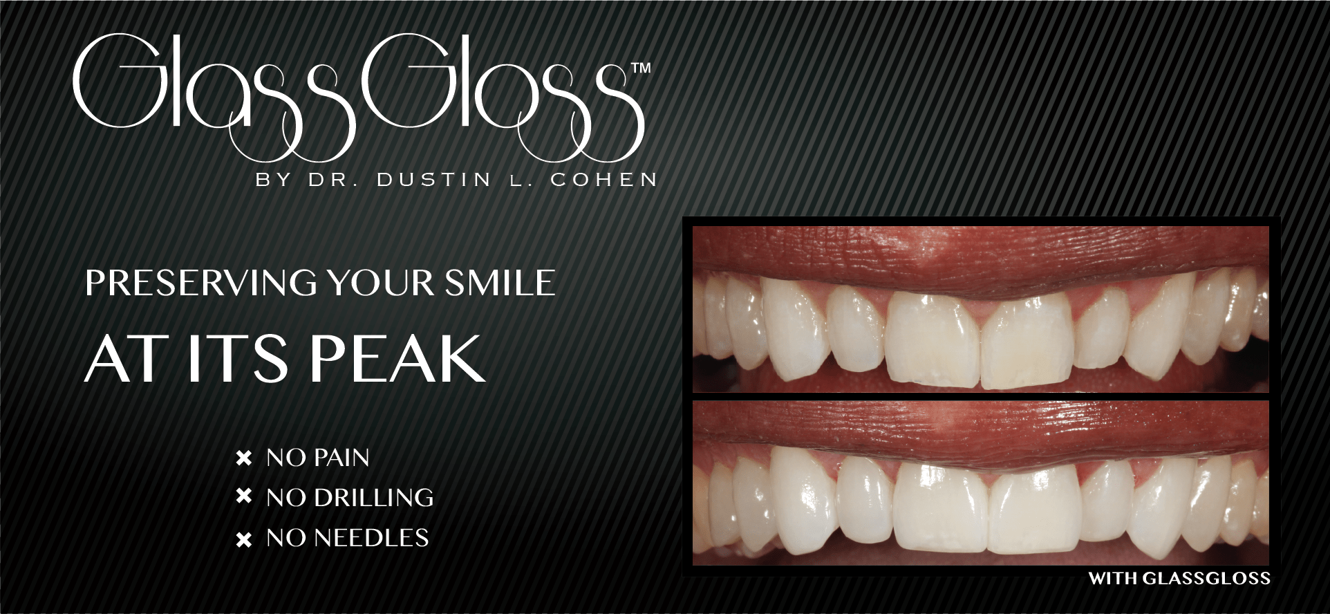 Tooth Protective Coating Dentistry in Beverly Hills, CA