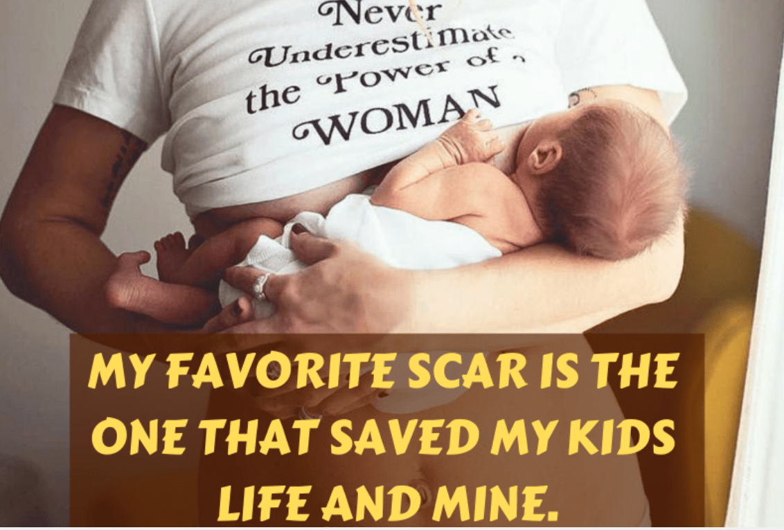 C Section Tips The Dad S Role During A Cesarean Delivery