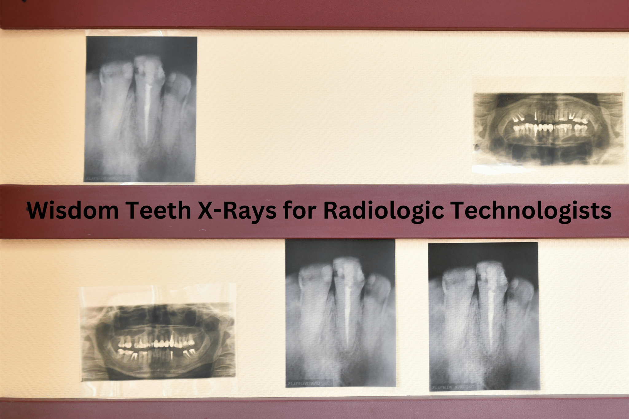Wisdom Teeth XRays for Radiologic Technologists