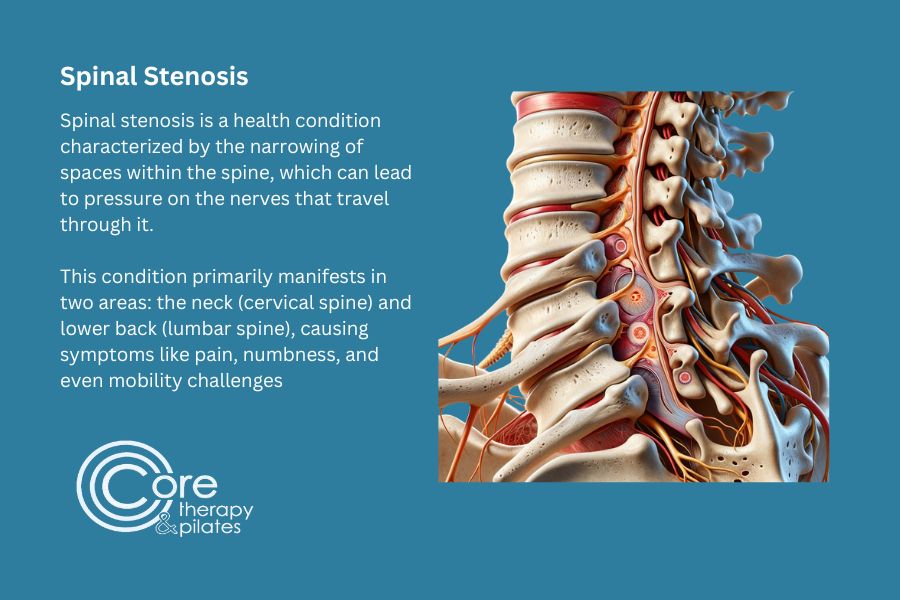 About Spinal Stenosis CORE Therapy & Pilates