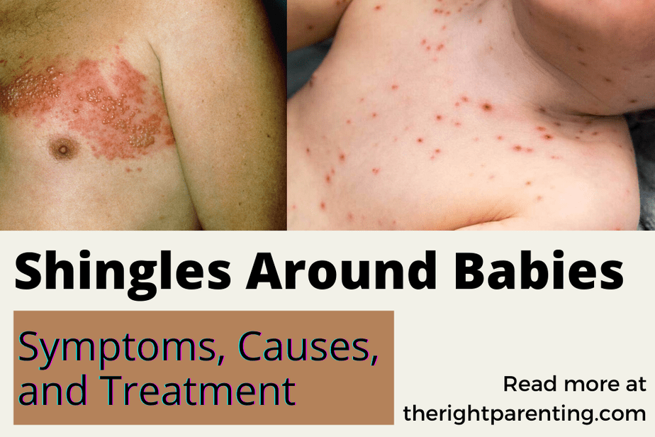 Shingles Around Babies Symptoms, Causes, and Treatment