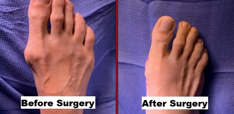 How to Get Smaller Feet with Surgery The Shoe Buddy
