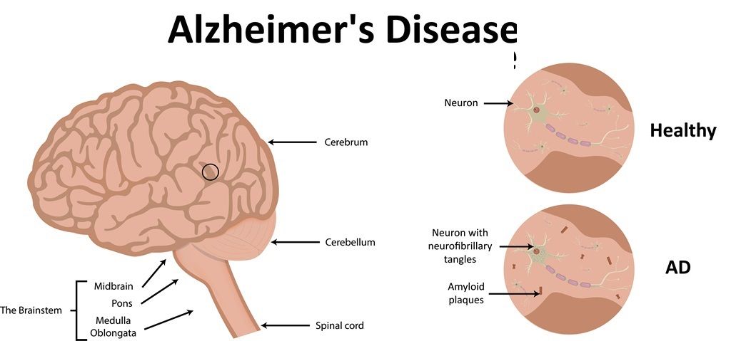 Alzheimer’s Disease Symptoms, Causes & Treatment of Alzheimer’s