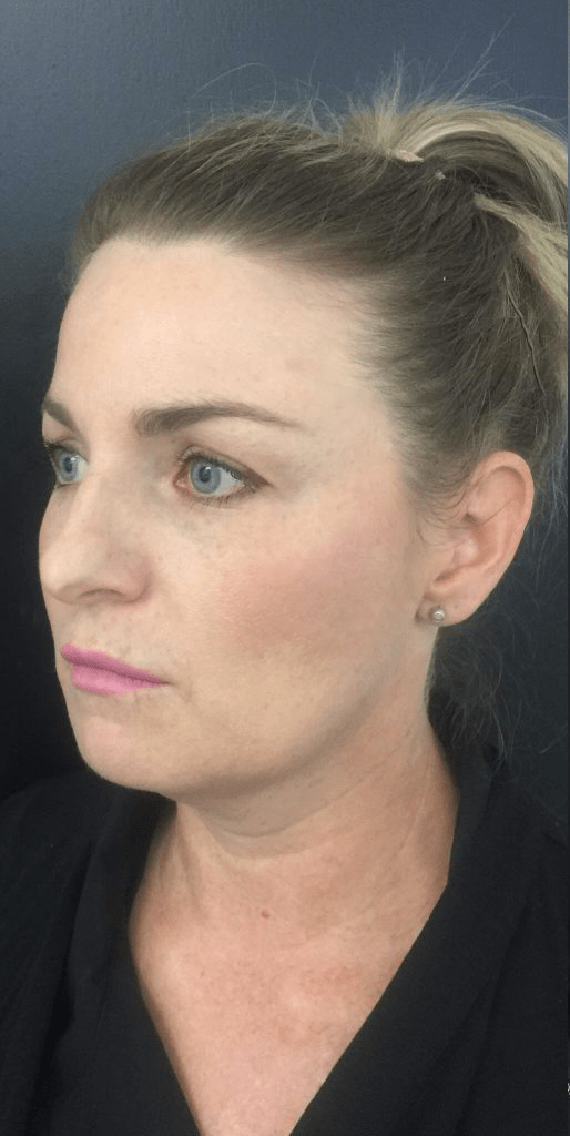 Cheek and Jawline Enhancement The Skin Clinic Faversham