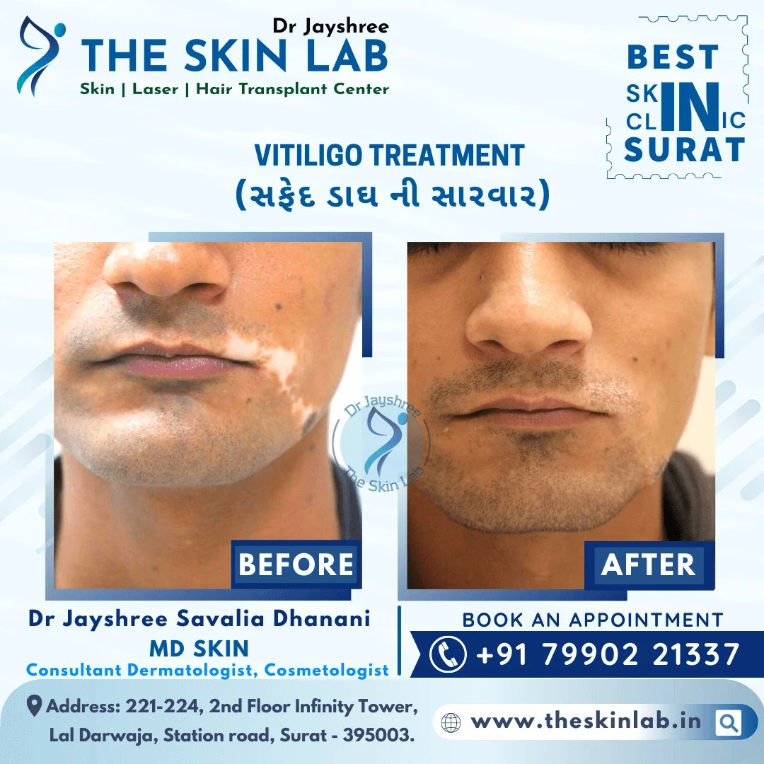 Best White Spot or Vitiligo Removal Treatment in Surat The Skin Lab