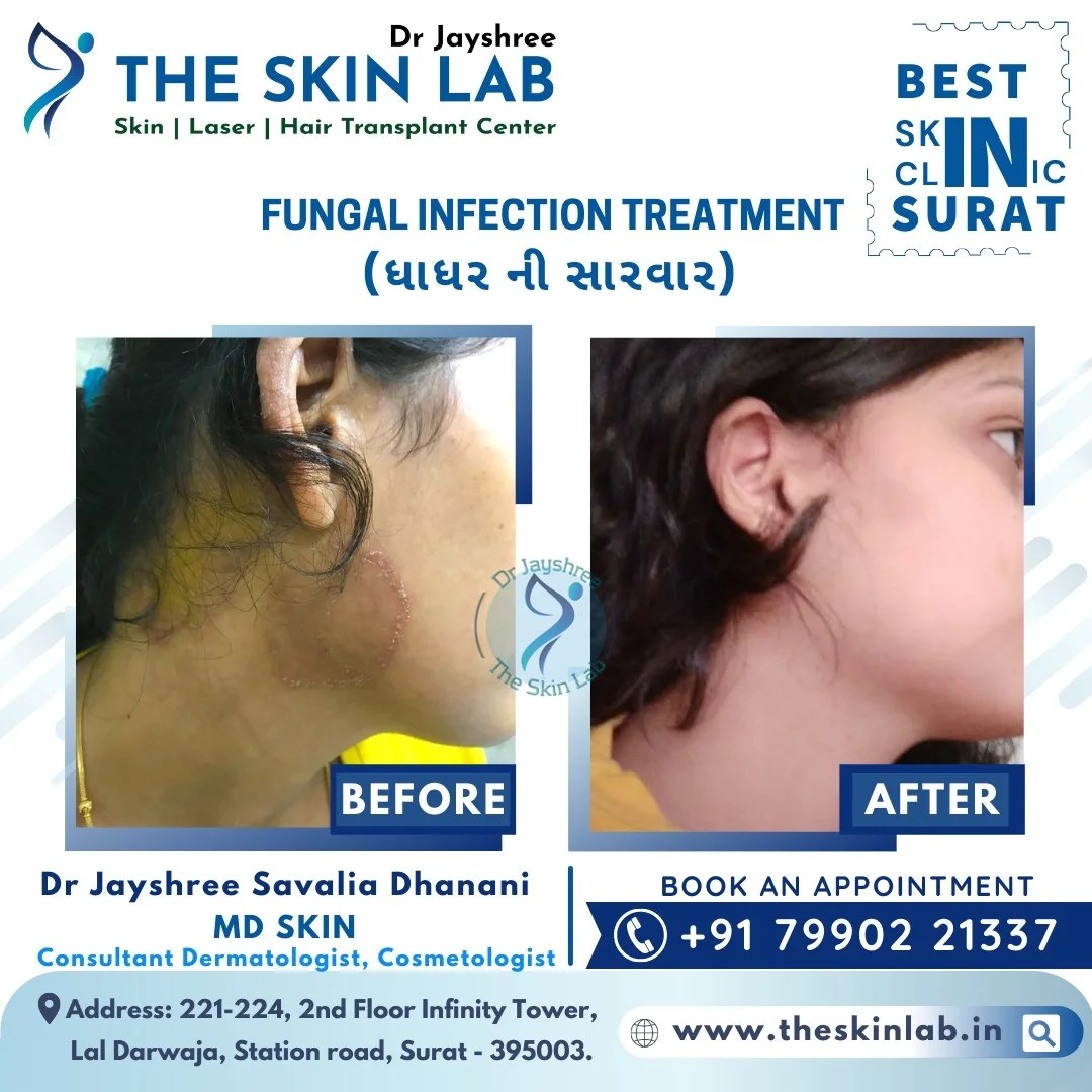 Fungal Skin Infection Specialist in Surat Dr Jayshree Savalia