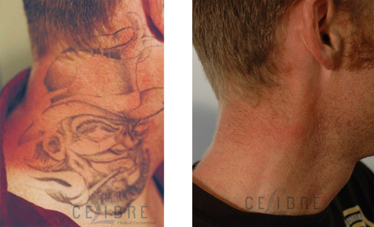 Is Laser Tattoo Removal Really Safe? The Skiny