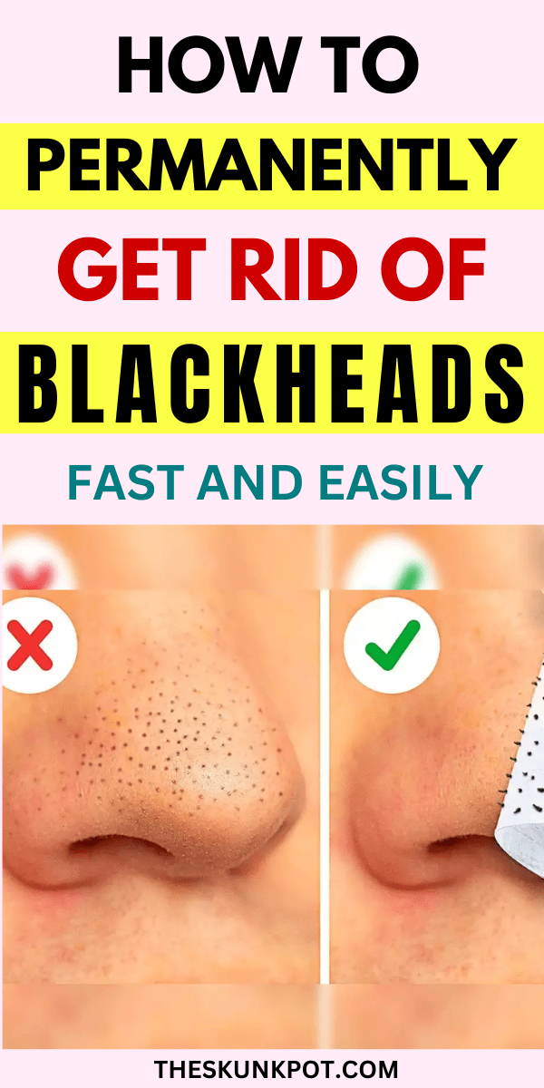 10 Methods How to Get Rid of Blackheads Fast and Easily