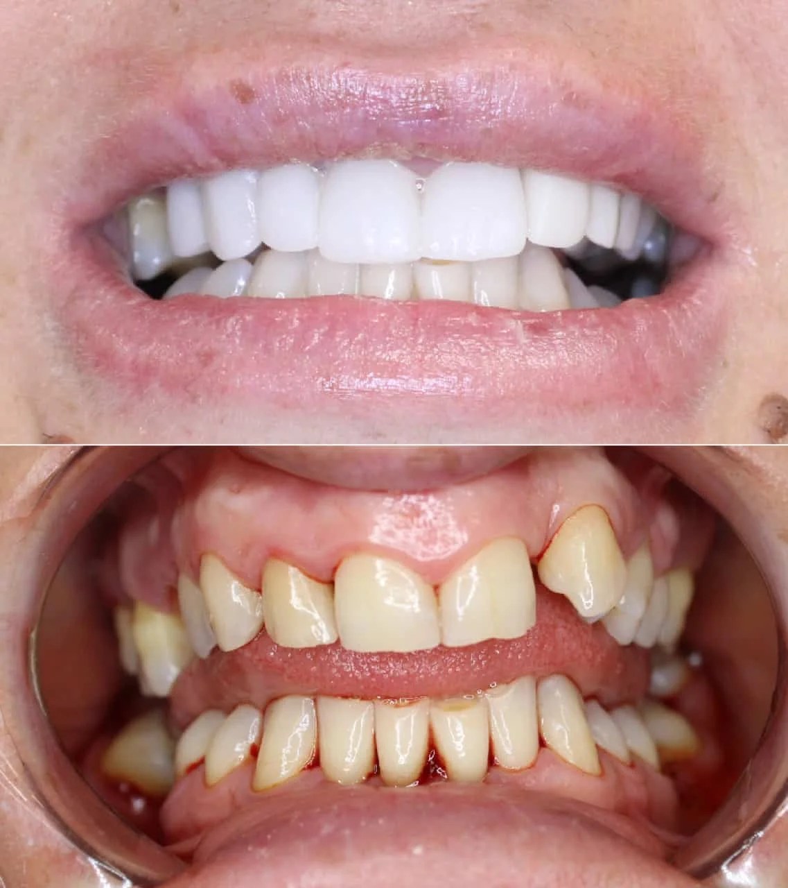 Veneers in Miami Dentist in Miami, FL The Smile Mission