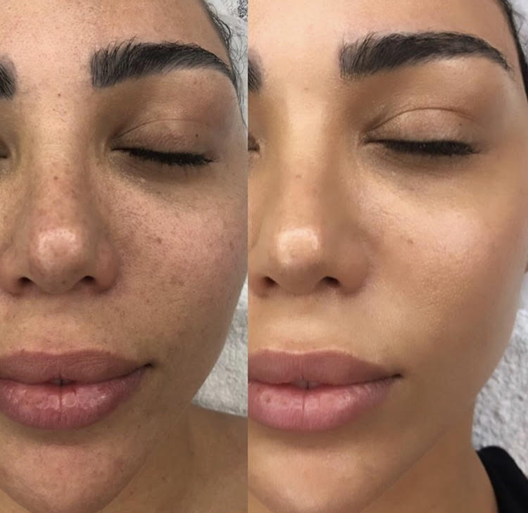 BB Glow Facial • The Source Medi Spa