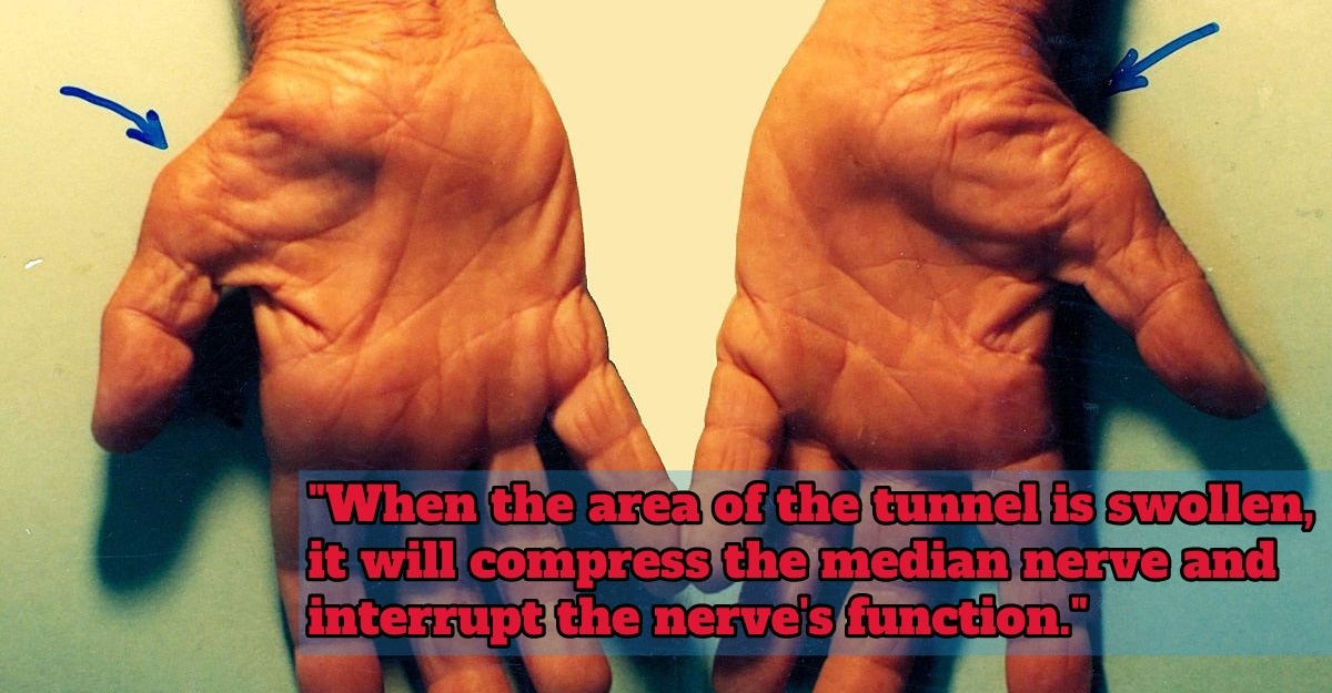 Hands Feel Numb Often? Signs of Carpal Tunnel Syndrome