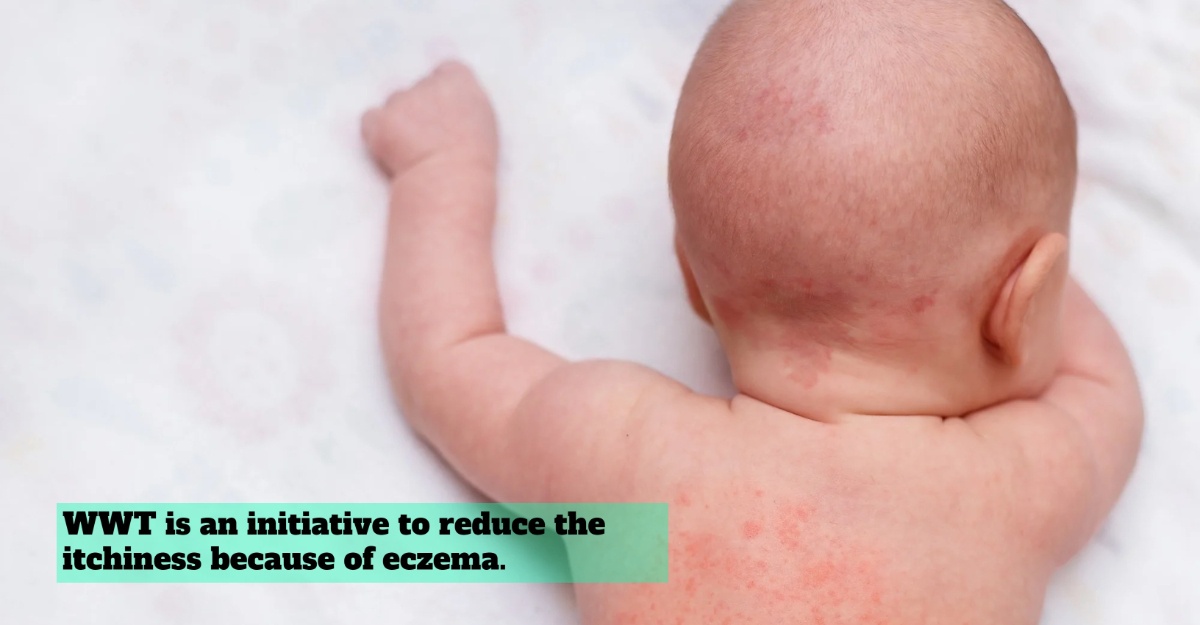 Knowing Wet Wrap Therapy (WWT) For Eczema