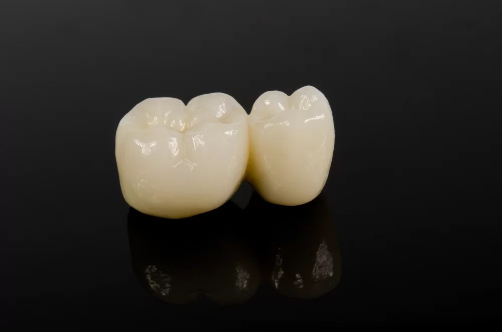 Dental Bridge Tooth Bridge Fill The Gap Auckland