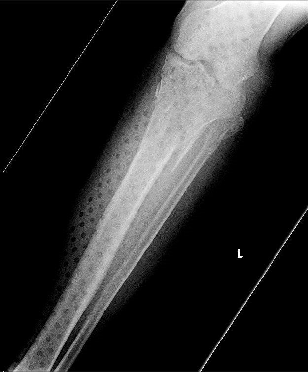 Metal Splints Can You Xray Through Them? The Trauma Pro