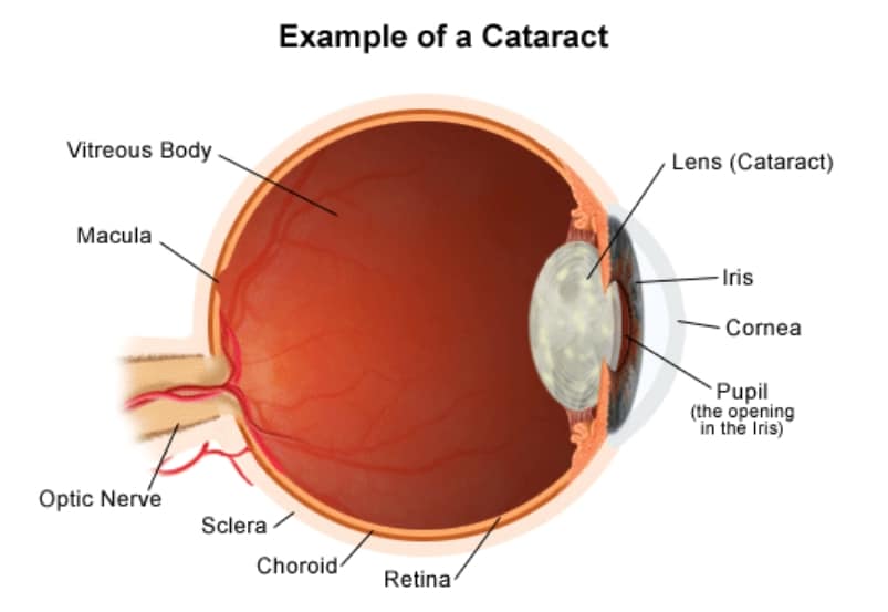 Cataracts Texas Vision and Laser Center