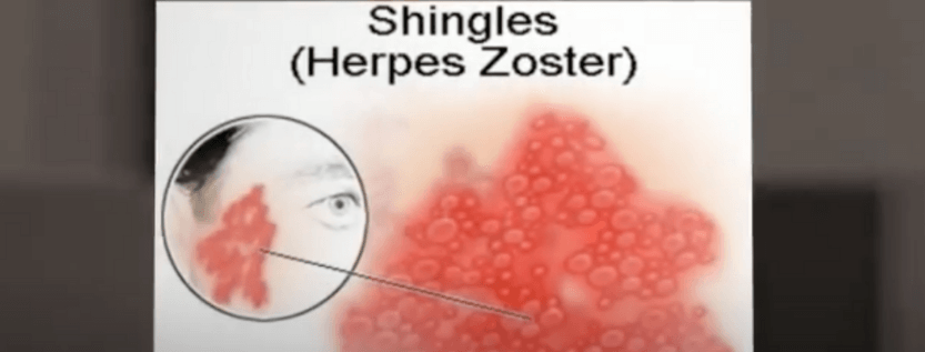 How Long Does Herpes Take To Show Up at Craigslist