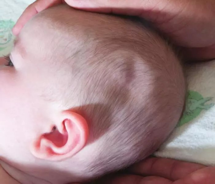 5 Common Birth Injury Symptoms in Infants The Washington Note