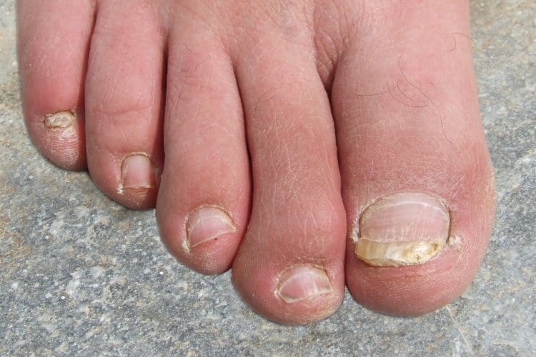 How to Treat a Bruised or Black Toenail from Running The Wired Runner