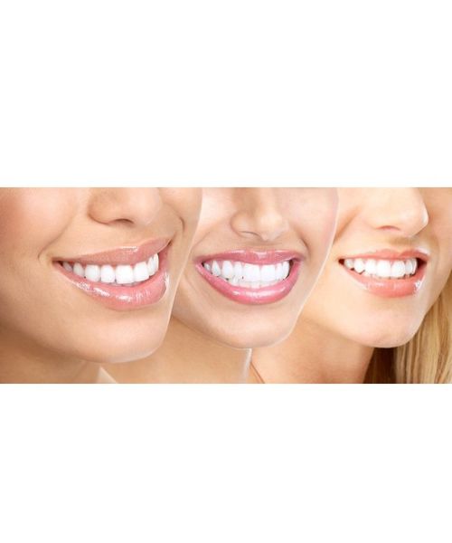 Professional DIY Teeth Whitening Kit