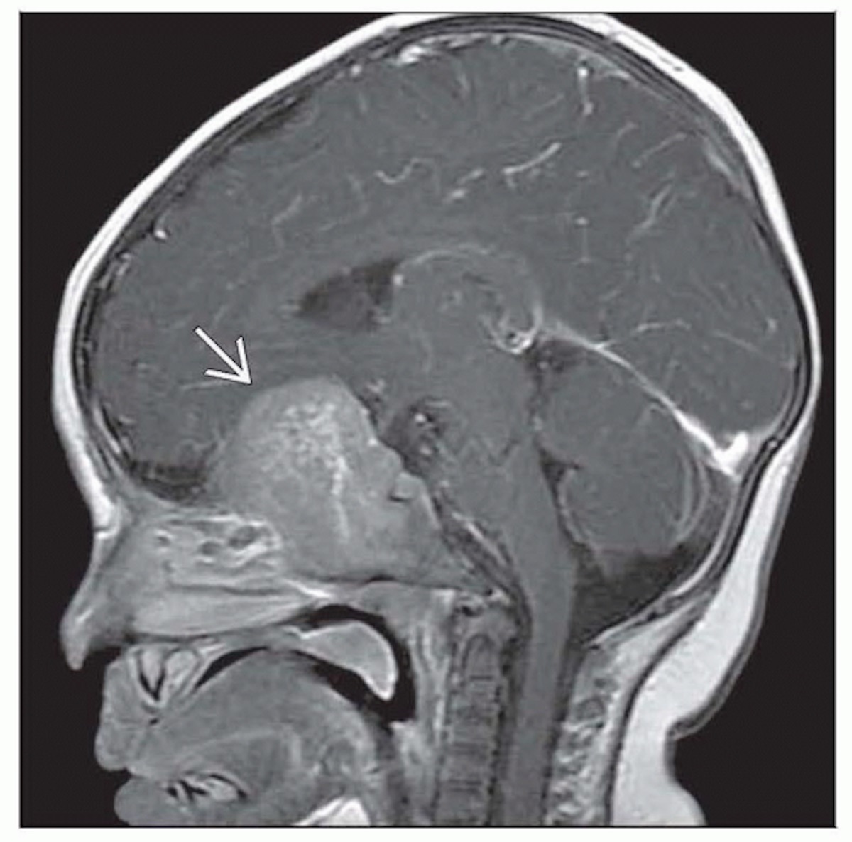 Types of Brain Cancers Page 9 Things Health