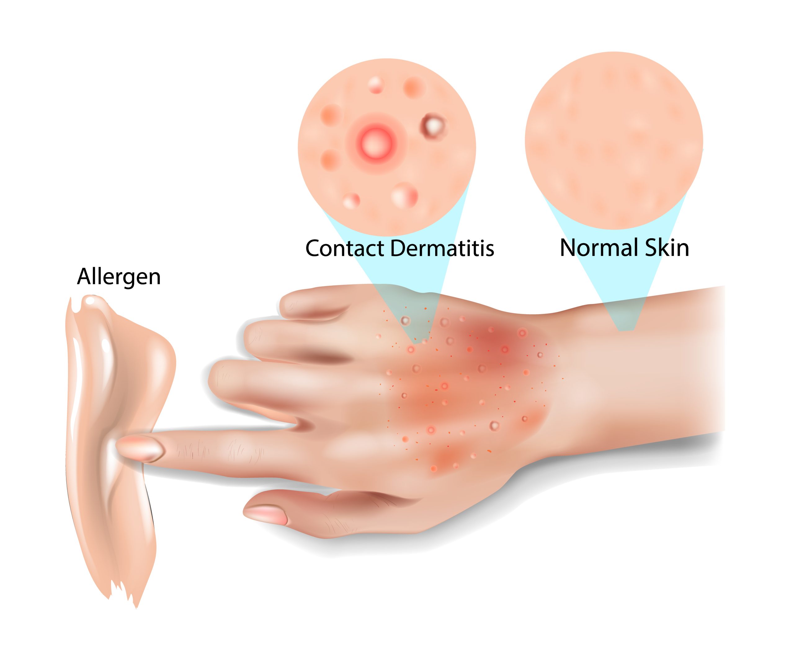 Understanding and Treating Contact Dermatitis