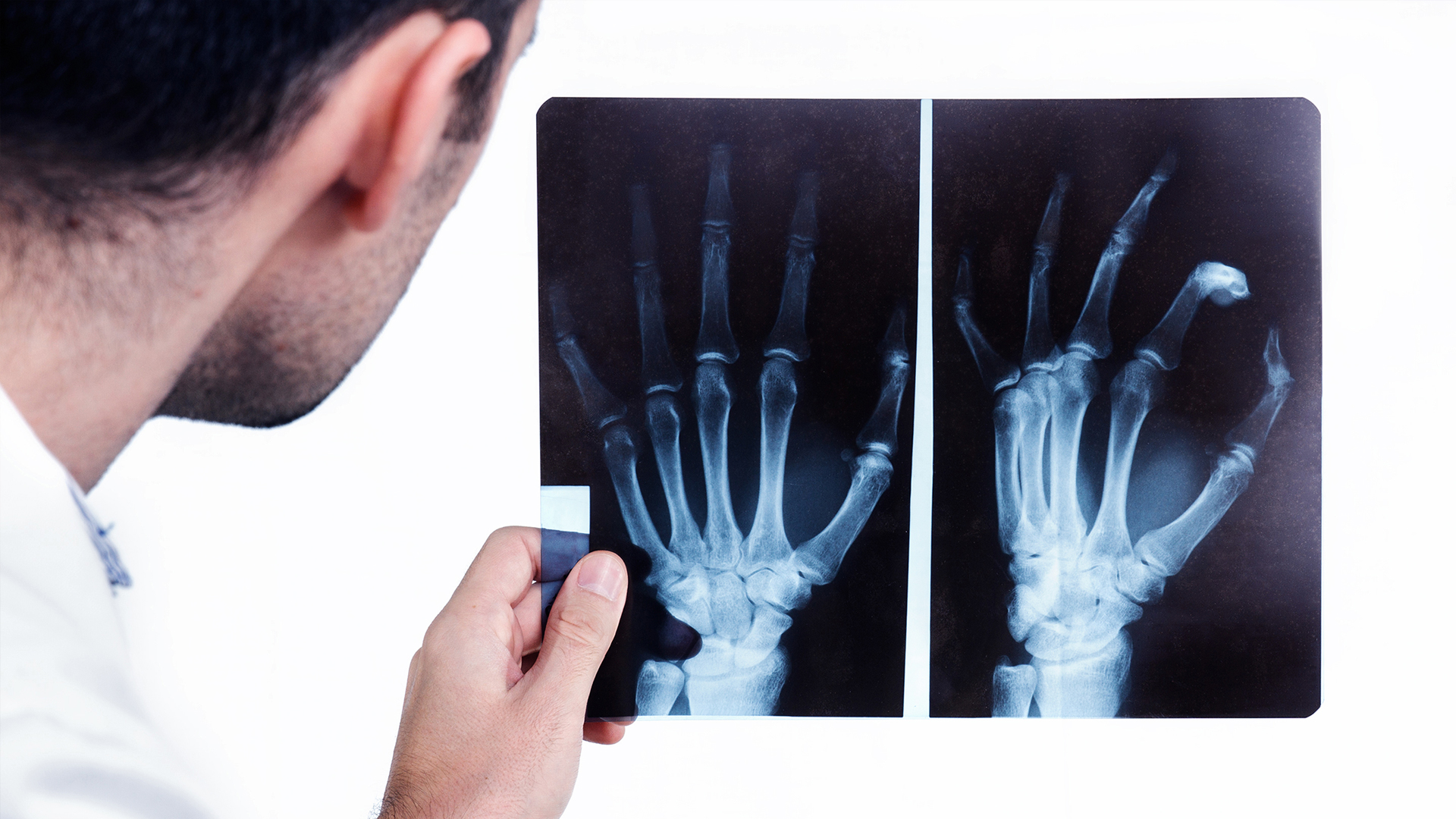 Diagnosing Rheumatoid Arthritis Video thirdAGE