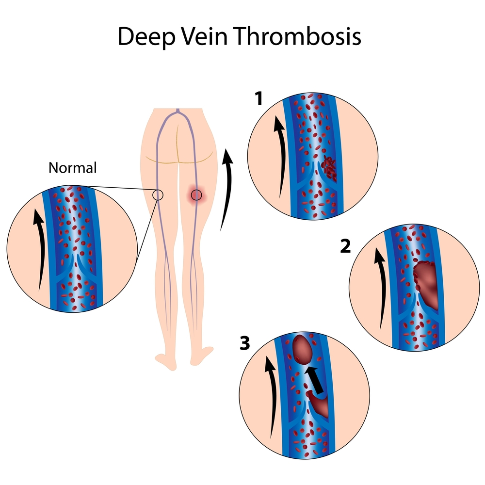 Deep Vein Thrombosis Information thirdAGE