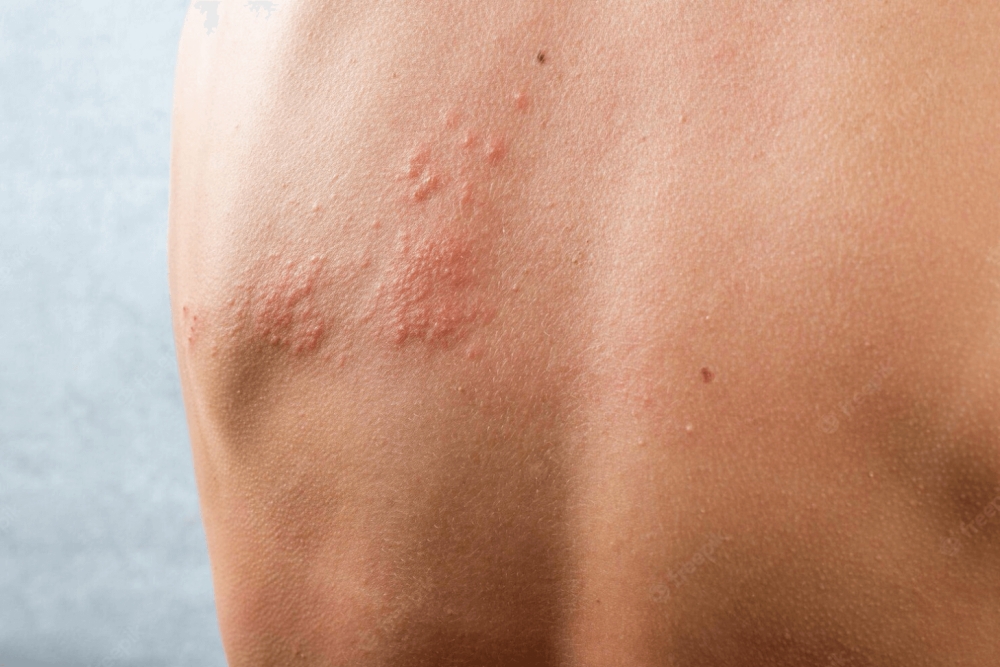 When Does Shingles Pain Peak? Understanding the Timing and Management
