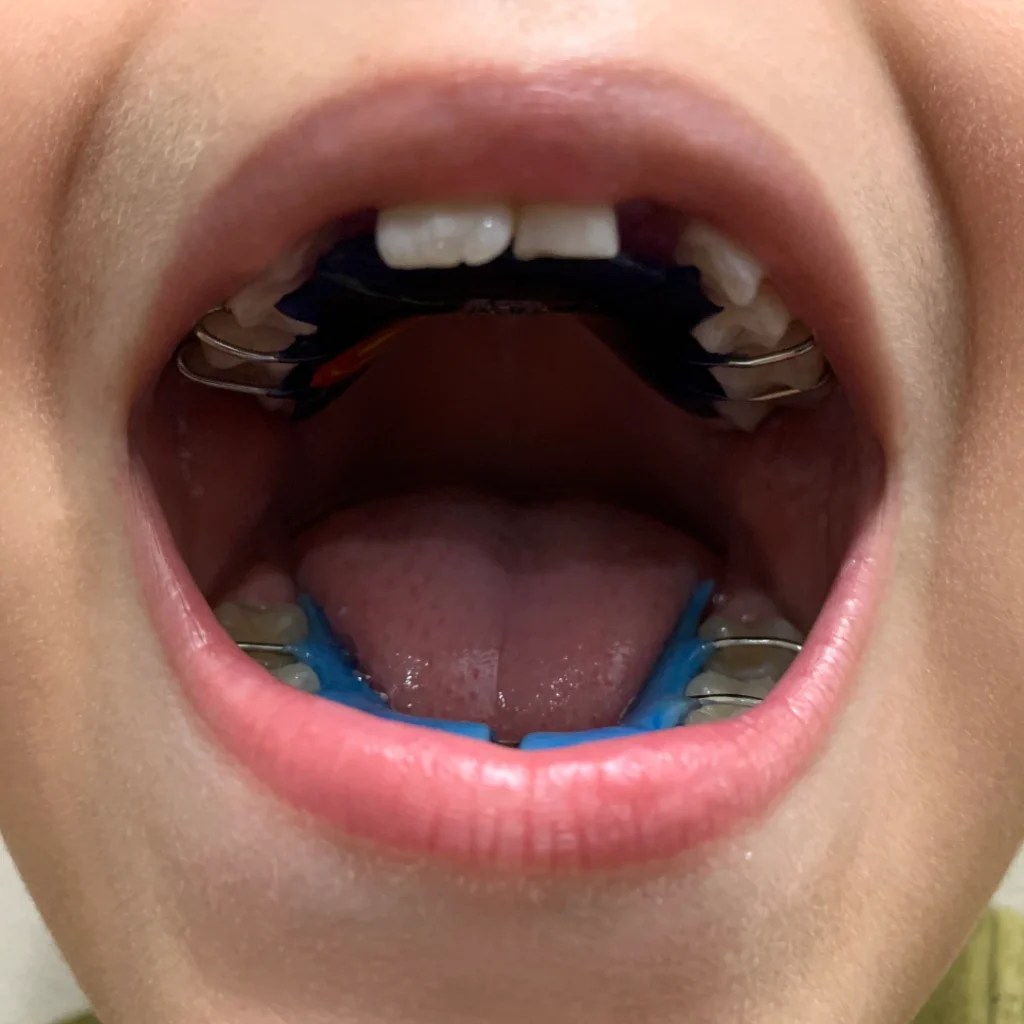 Does Your Child Need Teeth Expanders? Find Out Now