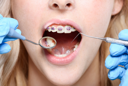 What's the Best Age to Get Braces? Thomas Orthodontics