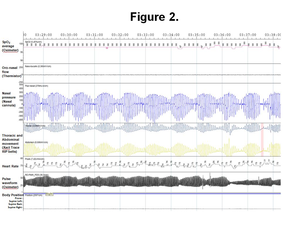 Prevalence and Characteristics of Central Compared to Obstructive Sleep