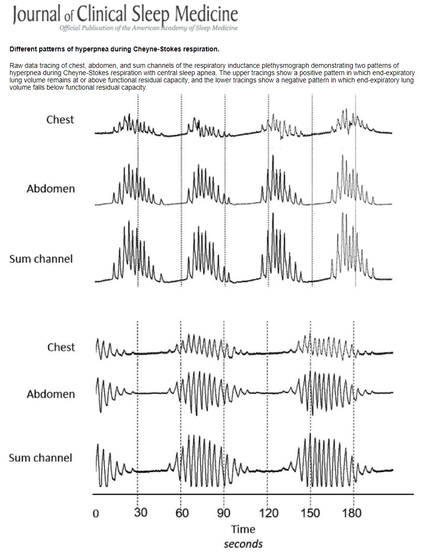 Two Distinct Patterns of Hyperpnea During CheyneStokes Respiration