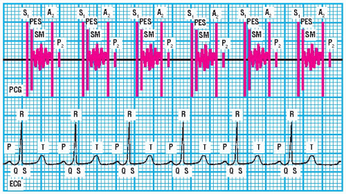 Systolic Murmurs Thoracic Key