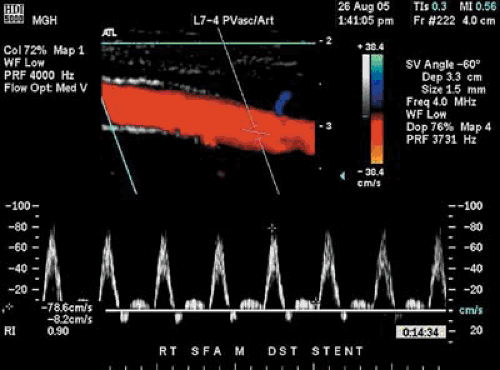 Noninvasive Assessment of Peripheral Vascular Disease Thoracic Key