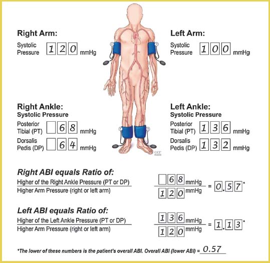 20 Best Ankle Brachial Index Chart
