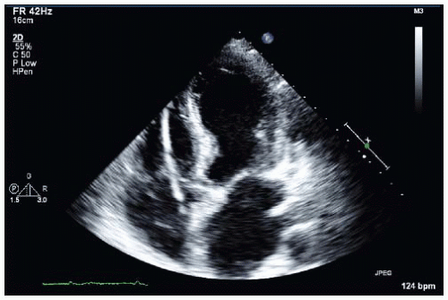 Emergent Lysis of Adhesions Thoracic Key