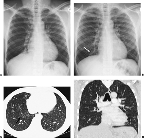 Pleura, Chest Wall, and Diaphragm Thoracic Key Pleura, Chest Wall, and Diaphragm Thoracic Key