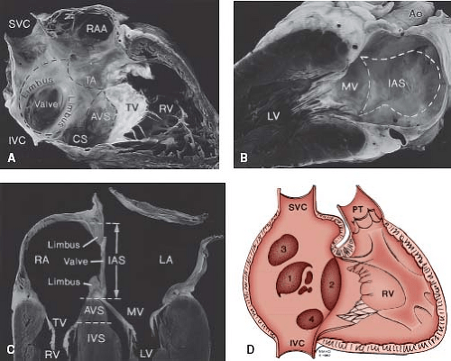 Atrial Septal Defects Thoracic Key