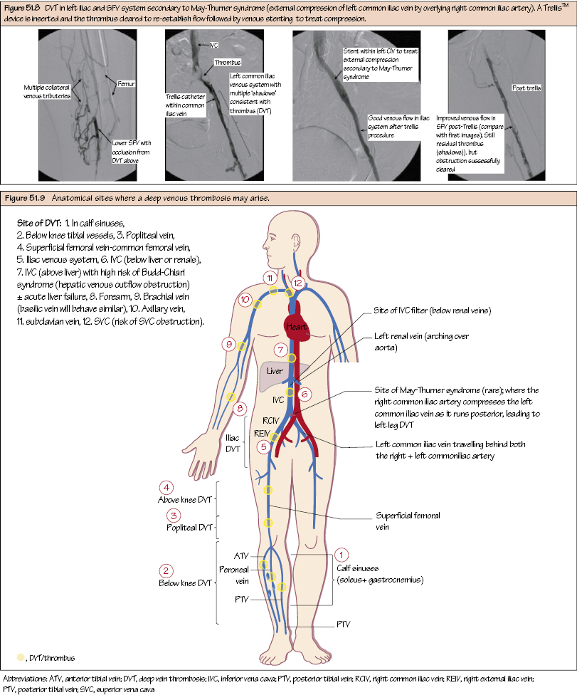 Deep Venous Thrombosis Thoracic Key