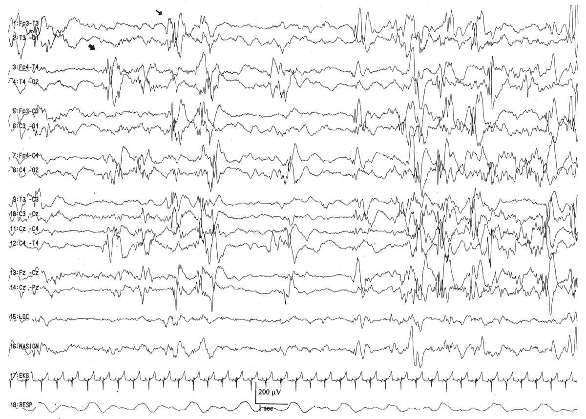 Normal Pediatric EEG Neonates and Children Thoracic Key