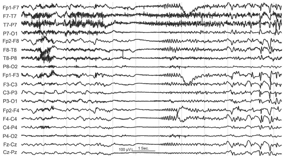 EEG in Adult Epilepsy Thoracic Key