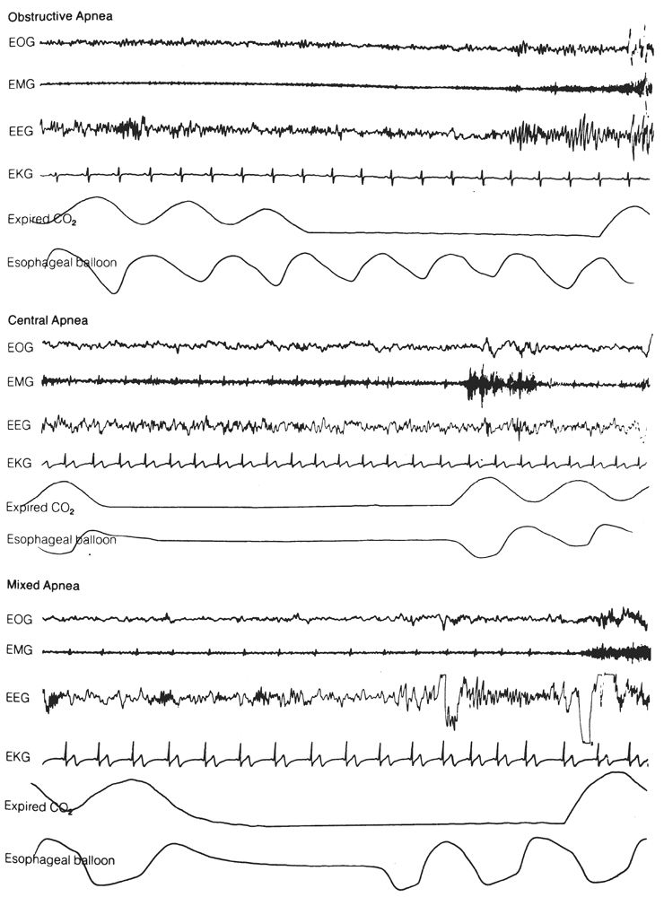 Sleep Disorders Laboratory Evaluation Thoracic Key