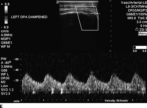 Biphasic Waveforms Arterial Leg Ultrasound