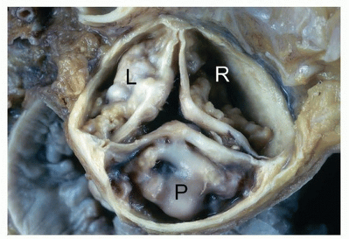 Degenerative Valve DiseaseCalcific Aortic Stenosis and Mitral Annular Degenerative Valve DiseaseCalcific Aortic Stenosis and Mitral Annular