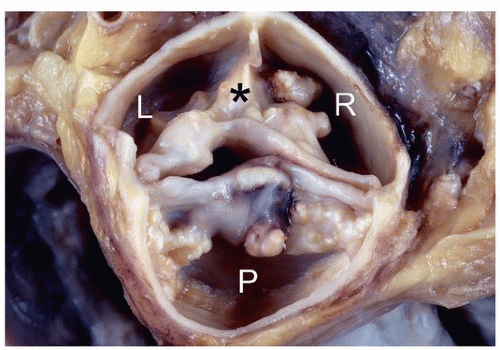 Degenerative Valve DiseaseCalcific Aortic Stenosis and Mitral Annular Degenerative Valve DiseaseCalcific Aortic Stenosis and Mitral Annular