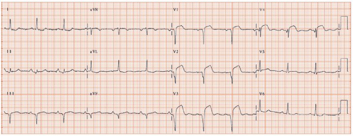Mitral valve disease Thoracic Key