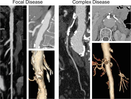 Techniques Of Endovascular Mesenteric Revascularization | Thoracic Key