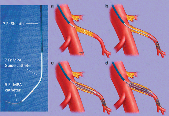 Techniques Of Endovascular Mesenteric Revascularization | Thoracic Key