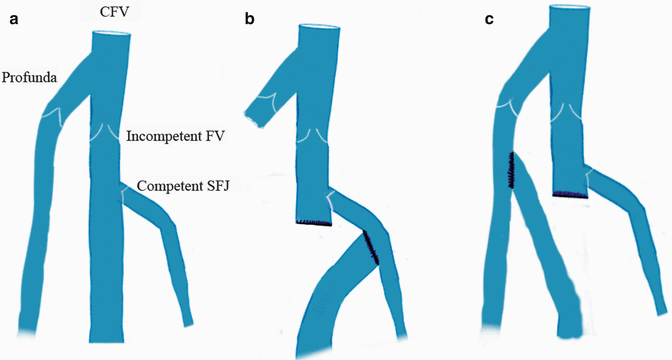 Deep Vein Valve Reconstruction | Thoracic Key