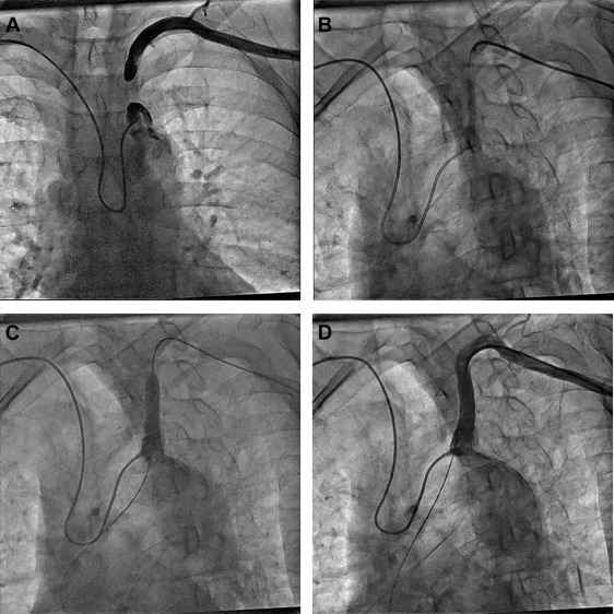 Results of Transradial Subclavian Artery Percutaneous Interventions After Bilateral or Single